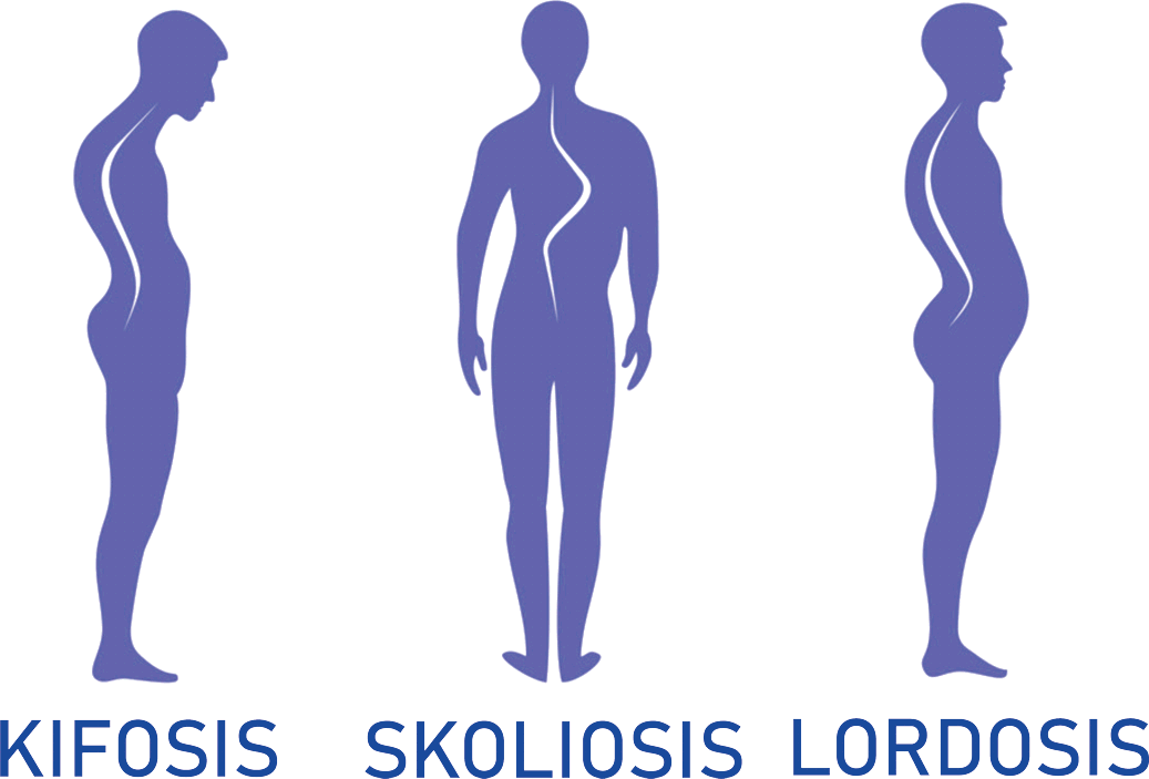 Kifosis, Skoliosis, dan Lordosis